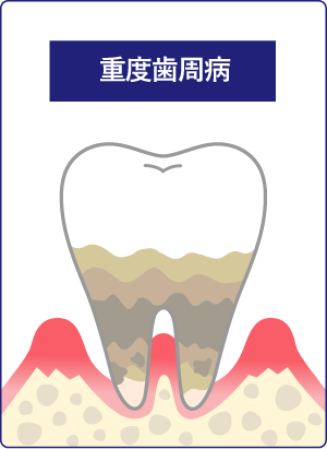 重度歯周病の画像